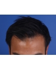 After Hair Transplant&nbsp;2 Sessions (Areas)
